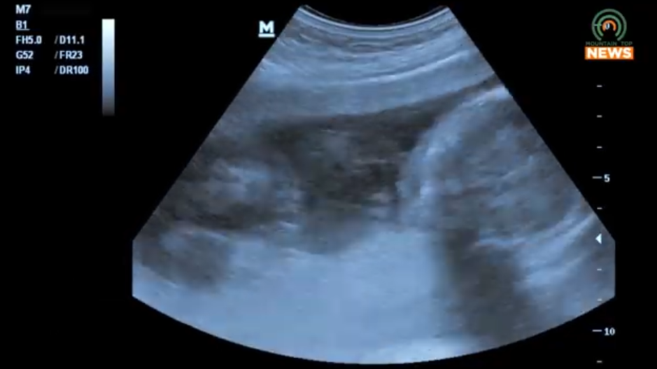 Dickenson County teen sues healthcare clinic, says staff aborted her baby against her will
